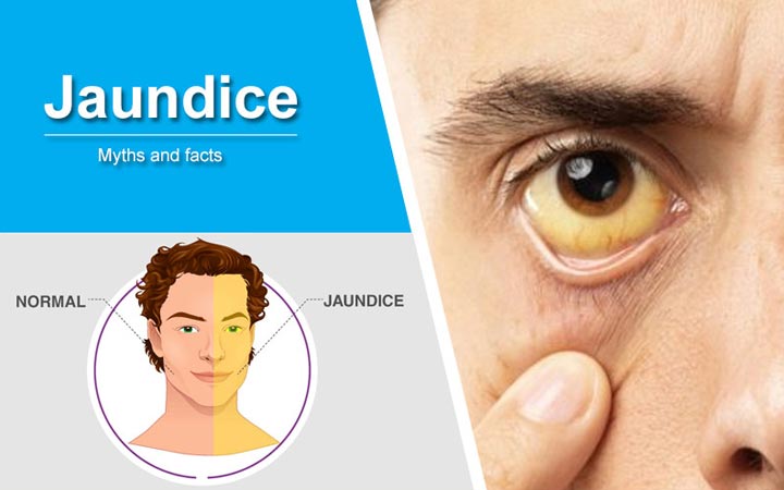 Jaundice Peelia Symptoms Causes Treatment